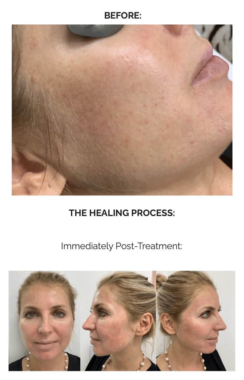 ฝ้าเลือด Telangiectatic Melasma ดูแลได้อย่างไร? ฝ้าเลือด Telangiectatic Melasma ดูแลได้อย่างไร?
