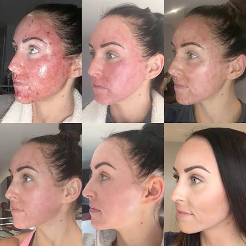 ฝ้าเลือด Telangiectatic Melasma ดูแลได้อย่างไร? ฝ้าเลือด Telangiectatic Melasma ดูแลได้อย่างไร?