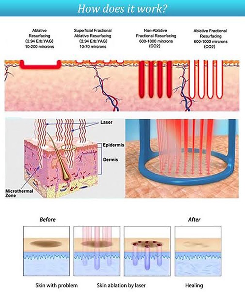 ฝ้าเลือด Telangiectatic Melasma ดูแลได้อย่างไร? ฝ้าเลือด Telangiectatic Melasma ดูแลได้อย่างไร?