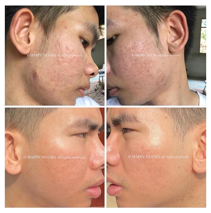 ดูแลหลุมสิวด้วยเลเซอร์กรอทั้งชั้นผิวเออร์เบียมแย๊กเลเซอร์ Fully Ablative 2940-nm Erbium YAG Laser ดูแลหลุมสิวด้วยเลเซอร์กรอทั้งชั้นผิวเออร์เบียมแย๊กเลเซอร์ Fully Ablative 2940-nm Erbium YAG Laser