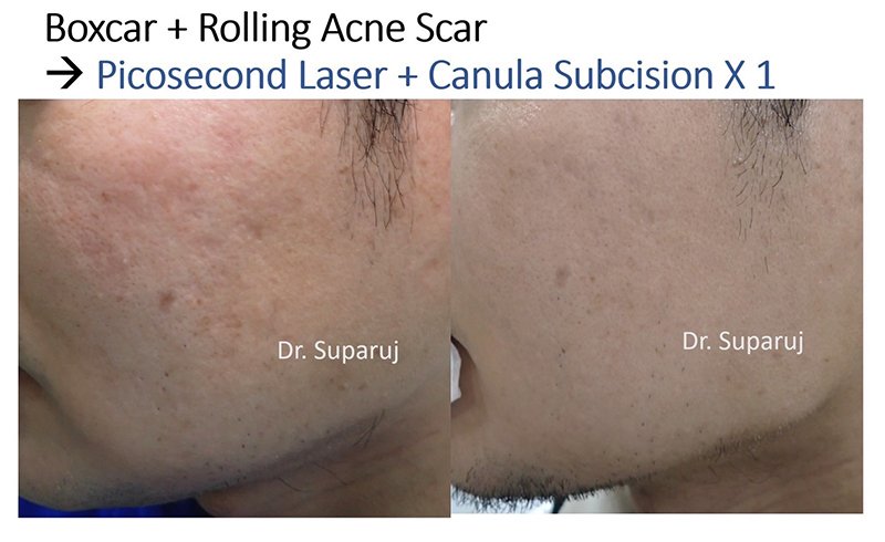 ดูแลหลุมสิวด้วยเลเซอร์กรอทั้งชั้นผิวเออร์เบียมแย๊กเลเซอร์ Fully Ablative 2940-nm Erbium YAG Laser ดูแลหลุมสิวด้วยเลเซอร์กรอทั้งชั้นผิวเออร์เบียมแย๊กเลเซอร์ Fully Ablative 2940-nm Erbium YAG Laser