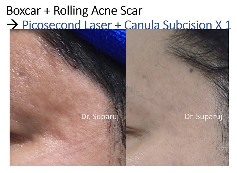 ดูแลหลุมสิวด้วยเลเซอร์กรอทั้งชั้นผิวเออร์เบียมแย๊กเลเซอร์ Fully Ablative 2940-nm Erbium YAG Laser ดูแลหลุมสิวด้วยเลเซอร์กรอทั้งชั้นผิวเออร์เบียมแย๊กเลเซอร์ Fully Ablative 2940-nm Erbium YAG Laser