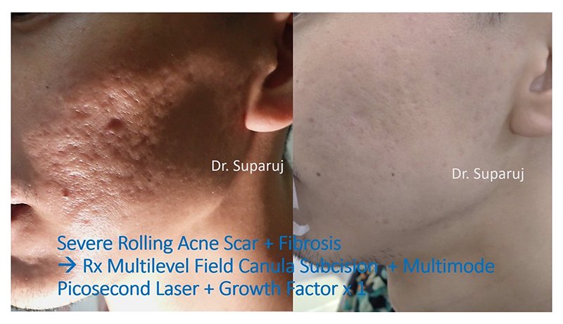 ดูแลหลุมสิวด้วยเลเซอร์กรอทั้งชั้นผิวเออร์เบียมแย๊กเลเซอร์ Fully Ablative 2940-nm Erbium YAG Laser ดูแลหลุมสิวด้วยเลเซอร์กรอทั้งชั้นผิวเออร์เบียมแย๊กเลเซอร์ Fully Ablative 2940-nm Erbium YAG Laser