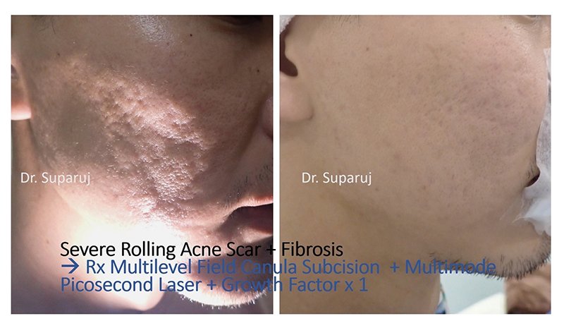 ดูแลหลุมสิวด้วยเลเซอร์กรอทั้งชั้นผิวเออร์เบียมแย๊กเลเซอร์ Fully Ablative 2940-nm Erbium YAG Laser ดูแลหลุมสิวด้วยเลเซอร์กรอทั้งชั้นผิวเออร์เบียมแย๊กเลเซอร์ Fully Ablative 2940-nm Erbium YAG Laser