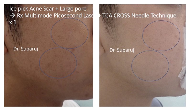 ดูแลหลุมสิวด้วยเลเซอร์กรอทั้งชั้นผิวเออร์เบียมแย๊กเลเซอร์ Fully Ablative 2940-nm Erbium YAG Laser ดูแลหลุมสิวด้วยเลเซอร์กรอทั้งชั้นผิวเออร์เบียมแย๊กเลเซอร์ Fully Ablative 2940-nm Erbium YAG Laser