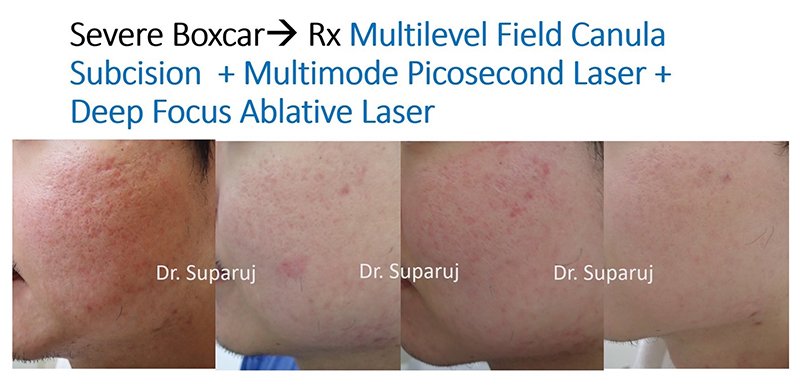 ดูแลหลุมสิวด้วยเลเซอร์กรอทั้งชั้นผิวเออร์เบียมแย๊กเลเซอร์ Fully Ablative 2940-nm Erbium YAG Laser ดูแลหลุมสิวด้วยเลเซอร์กรอทั้งชั้นผิวเออร์เบียมแย๊กเลเซอร์ Fully Ablative 2940-nm Erbium YAG Laser