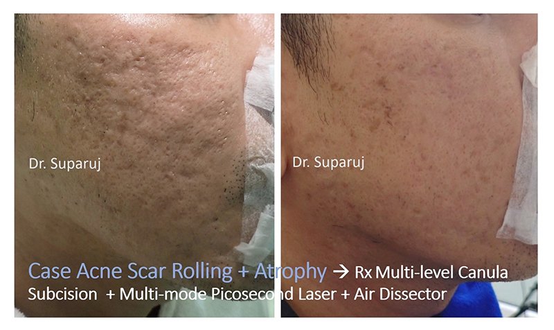 ดูแลหลุมสิวด้วยเลเซอร์กรอทั้งชั้นผิวเออร์เบียมแย๊กเลเซอร์ Fully Ablative 2940-nm Erbium YAG Laser ดูแลหลุมสิวด้วยเลเซอร์กรอทั้งชั้นผิวเออร์เบียมแย๊กเลเซอร์ Fully Ablative 2940-nm Erbium YAG Laser