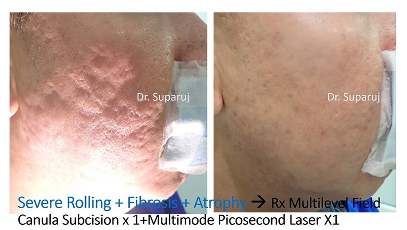 ดูแลหลุมสิวด้วยเลเซอร์กรอทั้งชั้นผิวเออร์เบียมแย๊กเลเซอร์ Fully Ablative 2940-nm Erbium YAG Laser ดูแลหลุมสิวด้วยเลเซอร์กรอทั้งชั้นผิวเออร์เบียมแย๊กเลเซอร์ Fully Ablative 2940-nm Erbium YAG Laser