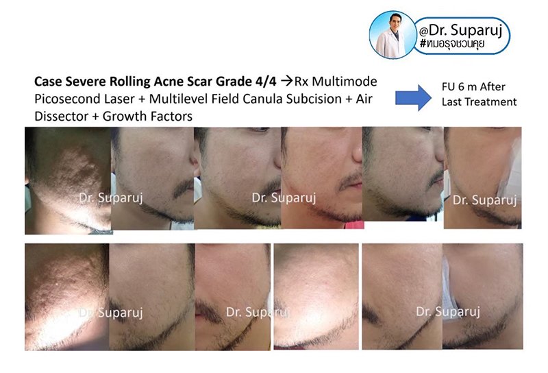 ดูแลหลุมสิวด้วยเลเซอร์กรอทั้งชั้นผิวเออร์เบียมแย๊กเลเซอร์ Fully Ablative 2940-nm Erbium YAG Laser ดูแลหลุมสิวด้วยเลเซอร์กรอทั้งชั้นผิวเออร์เบียมแย๊กเลเซอร์ Fully Ablative 2940-nm Erbium YAG Laser