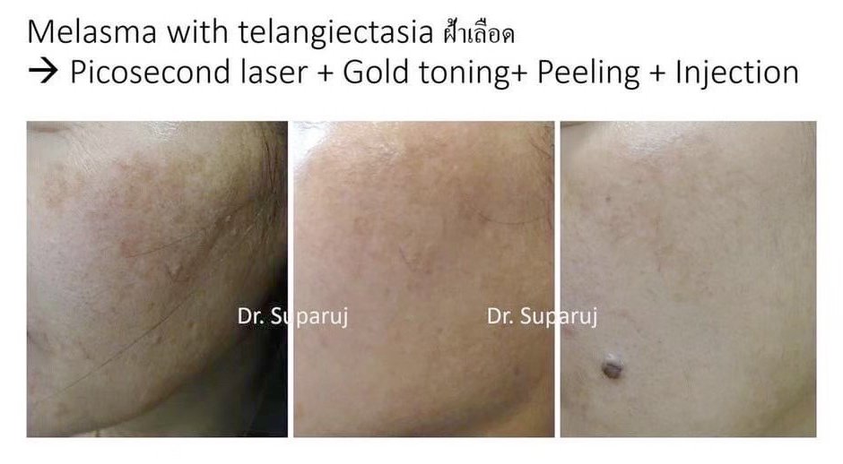 เทคนิคดูแลฝ้าด้วย Picosecond laser เทคนิคดูแลฝ้าด้วย Picosecond laser