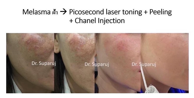 เทคนิคดูแลฝ้าด้วย Picosecond laser เทคนิคดูแลฝ้าด้วย Picosecond laser