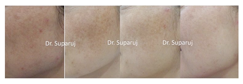 เทคนิคดูแลฝ้าด้วย Picosecond laser เทคนิคดูแลฝ้าด้วย Picosecond laser