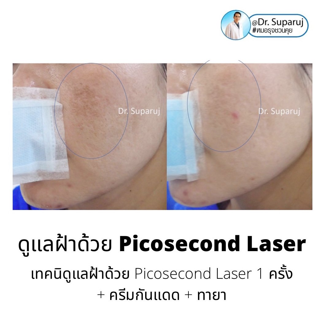 เทคนิคดูแลฝ้าด้วย Picosecond laser