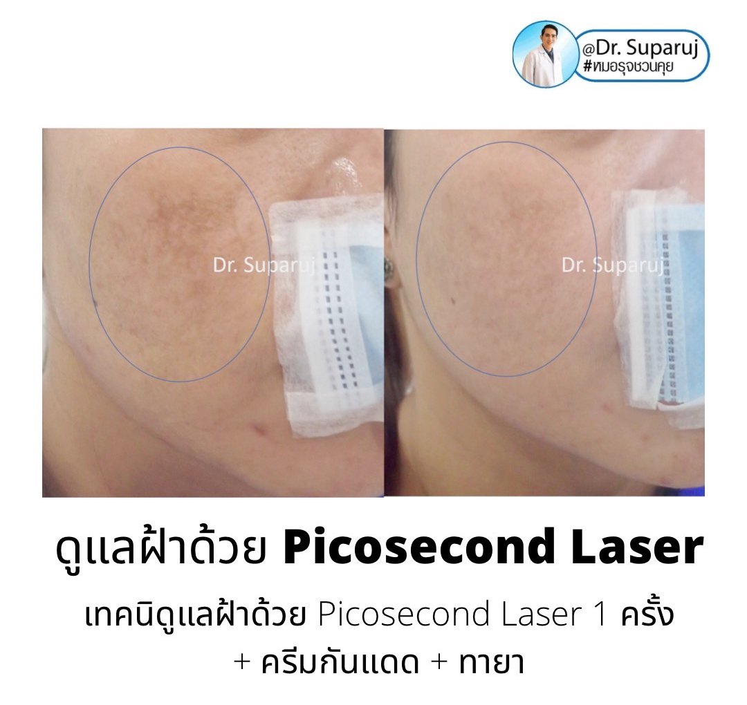 เทคนิคดูแลฝ้าด้วย Picosecond laser