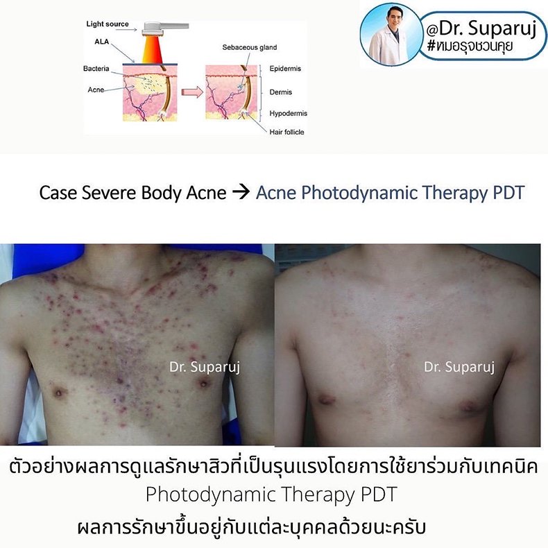 อาหารทำให้สิวดีขึ้นหรือแย่ลงได้ไหม? อาหารทำให้สิวดีขึ้นหรือแย่ลงได้ไหม?