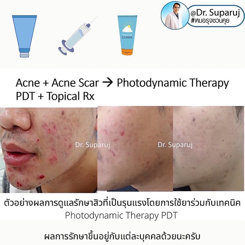 อาหารทำให้สิวดีขึ้นหรือแย่ลงได้ไหม? อาหารทำให้สิวดีขึ้นหรือแย่ลงได้ไหม?