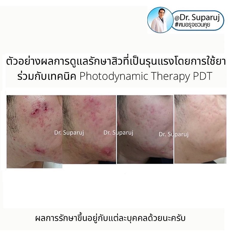 อาหารทำให้สิวดีขึ้นหรือแย่ลงได้ไหม? อาหารทำให้สิวดีขึ้นหรือแย่ลงได้ไหม?