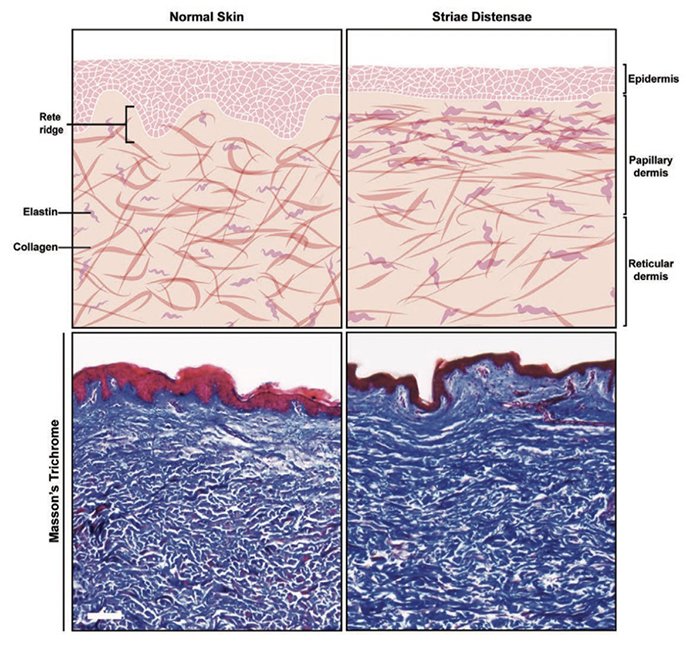 ผิวแตกลาย หรือ รอยแตกลาย (Stretch Mark หรือ Striae) ดูแลได้อย่างไร ? ผิวแตกลาย หรือ รอยแตกลาย (Stretch Mark หรือ Striae) ดูแลได้อย่างไร ?