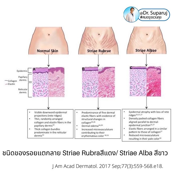 ผิวแตกลาย หรือ รอยแตกลาย (Stretch Mark หรือ Striae) ดูแลได้อย่างไร ? ผิวแตกลาย หรือ รอยแตกลาย (Stretch Mark หรือ Striae) ดูแลได้อย่างไร ?