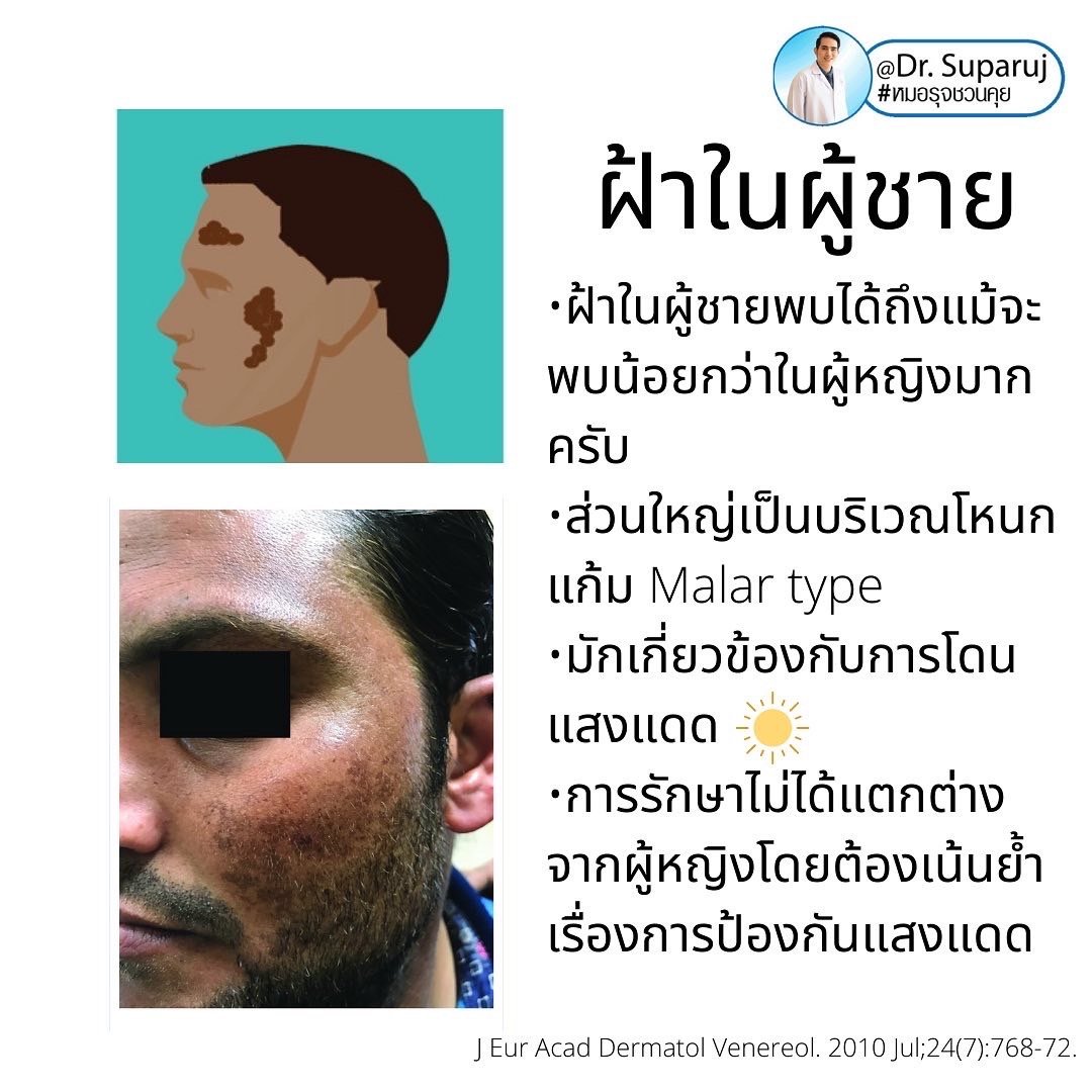 ฝ้าในผู้ชายต่างกับผู้หญิงอย่างไร? รักษาต่างกันอย่างไร? ฝ้าในผู้ชายต่างกับผู้หญิงอย่างไร? รักษาต่างกันอย่างไร?