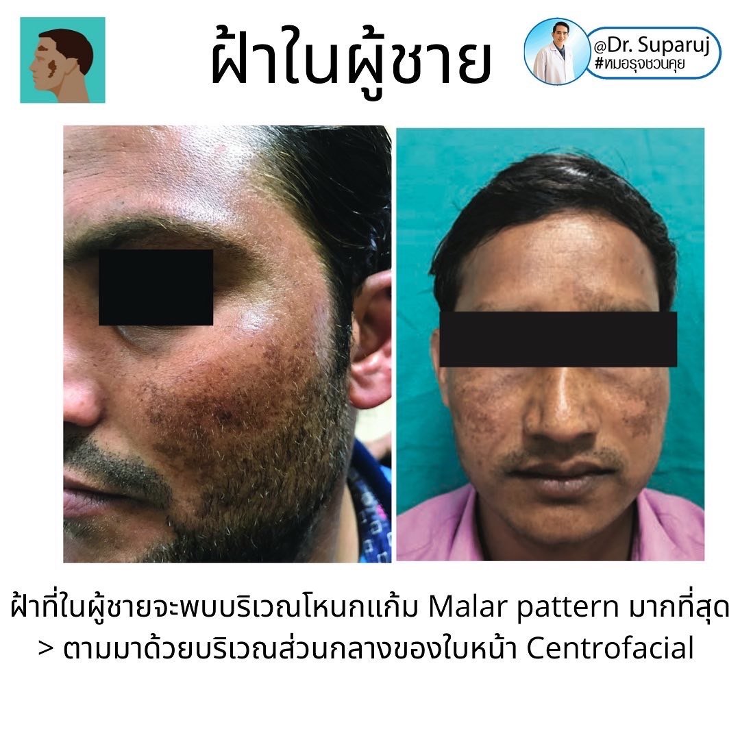 ฝ้าในผู้ชายต่างกับผู้หญิงอย่างไร? รักษาต่างกันอย่างไร? ฝ้าในผู้ชายต่างกับผู้หญิงอย่างไร? รักษาต่างกันอย่างไร?