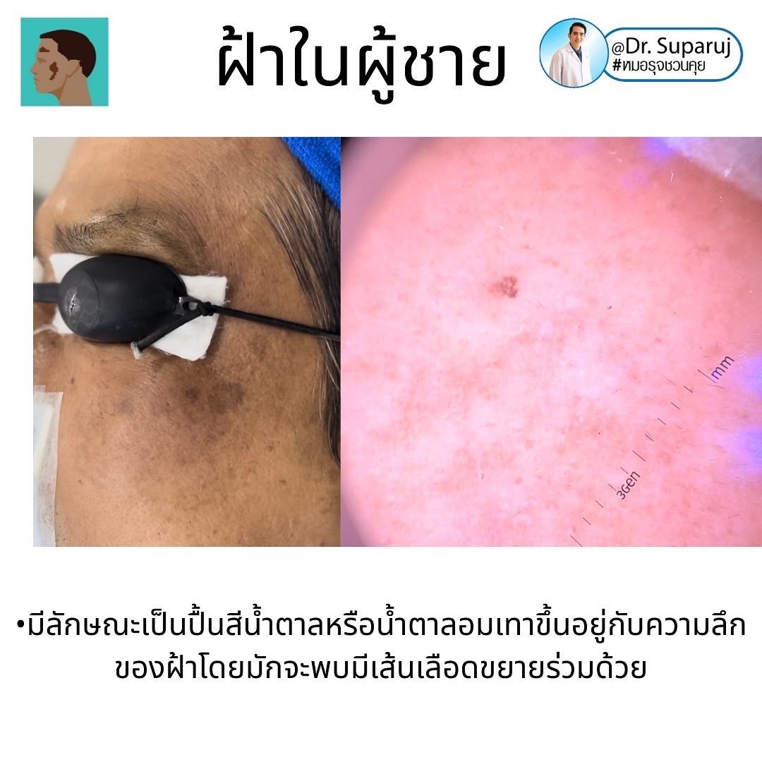 ฝ้าในผู้ชายต่างกับผู้หญิงอย่างไร? รักษาต่างกันอย่างไร? ฝ้าในผู้ชายต่างกับผู้หญิงอย่างไร? รักษาต่างกันอย่างไร?