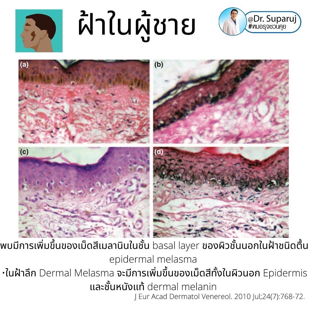 ฝ้าในผู้ชายต่างกับผู้หญิงอย่างไร? รักษาต่างกันอย่างไร? ฝ้าในผู้ชายต่างกับผู้หญิงอย่างไร? รักษาต่างกันอย่างไร?