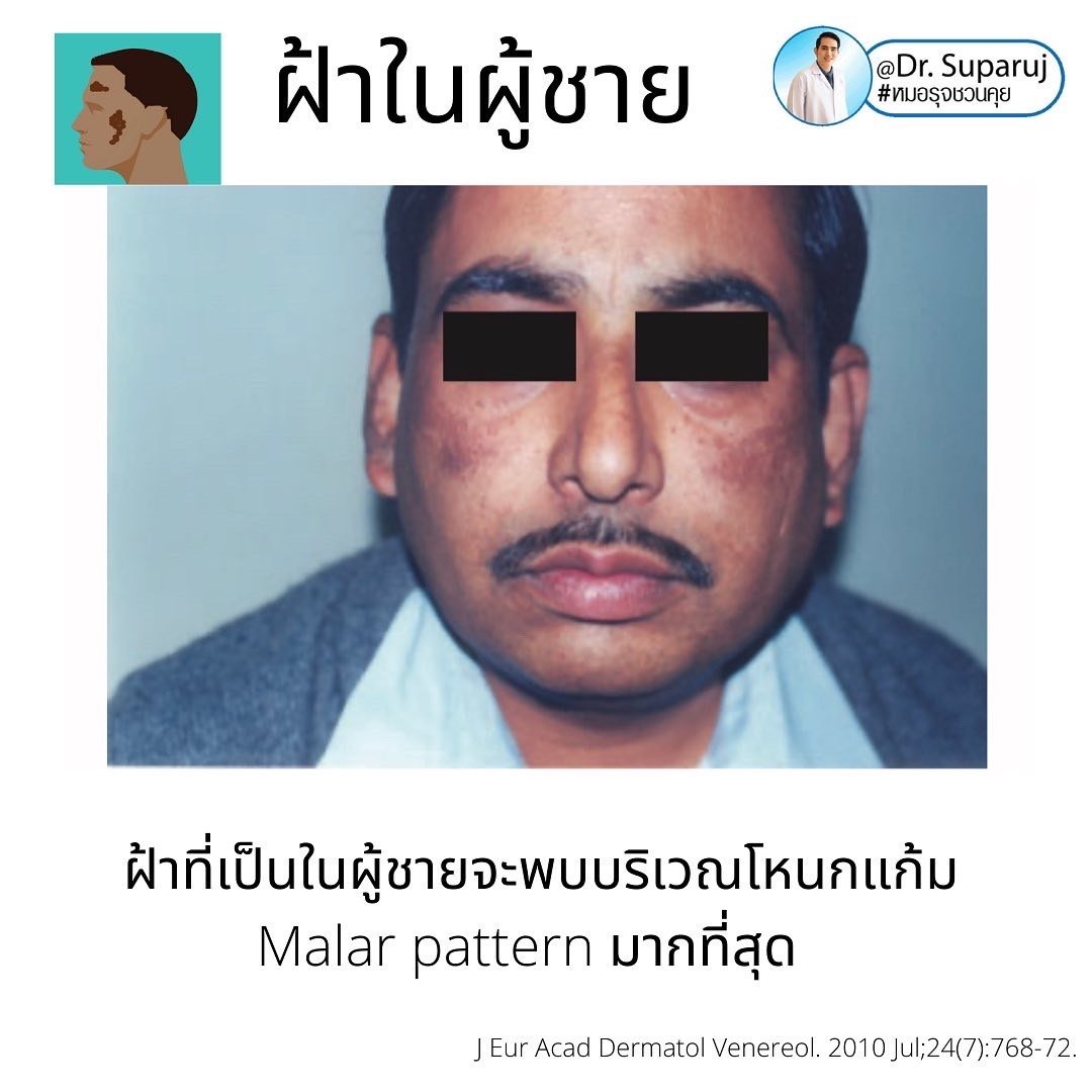 ฝ้าในผู้ชายต่างกับผู้หญิงอย่างไร? รักษาต่างกันอย่างไร? ฝ้าในผู้ชายต่างกับผู้หญิงอย่างไร? รักษาต่างกันอย่างไร?