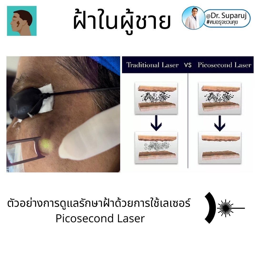 ฝ้าในผู้ชายต่างกับผู้หญิงอย่างไร? รักษาต่างกันอย่างไร? ฝ้าในผู้ชายต่างกับผู้หญิงอย่างไร? รักษาต่างกันอย่างไร?