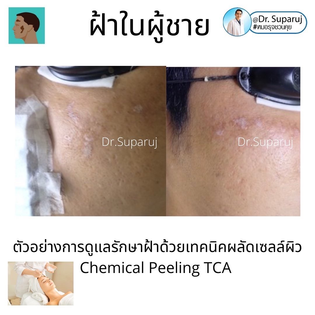 ฝ้าในผู้ชายต่างกับผู้หญิงอย่างไร? รักษาต่างกันอย่างไร?