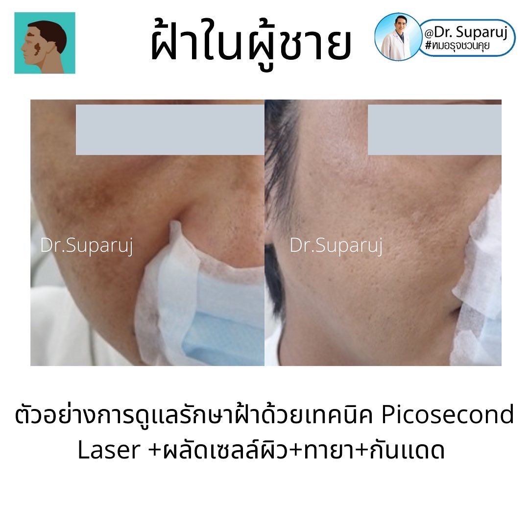 ฝ้าในผู้ชายต่างกับผู้หญิงอย่างไร? รักษาต่างกันอย่างไร? ฝ้าในผู้ชายต่างกับผู้หญิงอย่างไร? รักษาต่างกันอย่างไร?