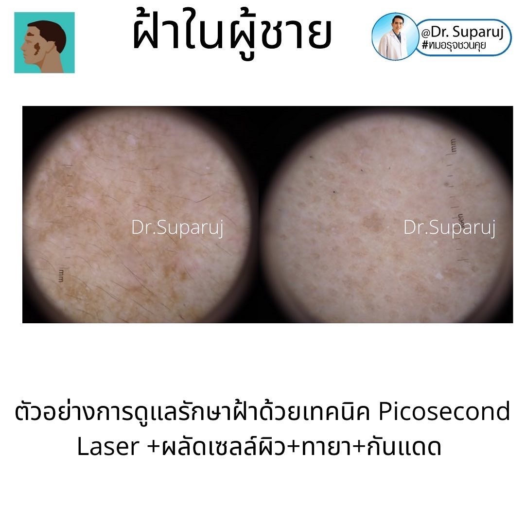 ฝ้าในผู้ชายต่างกับผู้หญิงอย่างไร? รักษาต่างกันอย่างไร? ฝ้าในผู้ชายต่างกับผู้หญิงอย่างไร? รักษาต่างกันอย่างไร?
