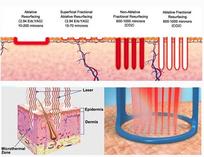 ดูแลฝ้าด้วยเทคนิคเลเซอร์ดึงเม็ดสีแบบแบ่งส่วน Fractional Laser for Melasma Treatment ดูแลฝ้าด้วยเทคนิคเลเซอร์ดึงเม็ดสีแบบแบ่งส่วน Fractional Laser for Melasma Treatment