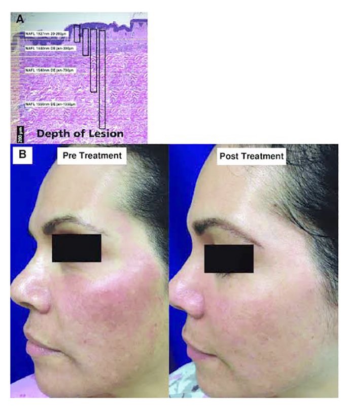 ดูแลฝ้าด้วยเทคนิคเลเซอร์ดึงเม็ดสีแบบแบ่งส่วน Fractional Laser for Melasma Treatment ดูแลฝ้าด้วยเทคนิคเลเซอร์ดึงเม็ดสีแบบแบ่งส่วน Fractional Laser for Melasma Treatment