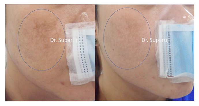 ดูแลฝ้าด้วยเทคนิคเลเซอร์ดึงเม็ดสีแบบแบ่งส่วน Fractional Laser for Melasma Treatment ดูแลฝ้าด้วยเทคนิคเลเซอร์ดึงเม็ดสีแบบแบ่งส่วน Fractional Laser for Melasma Treatment