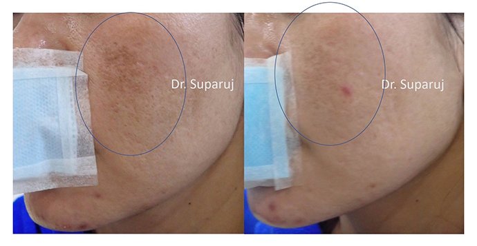 ดูแลฝ้าด้วยเทคนิคเลเซอร์ดึงเม็ดสีแบบแบ่งส่วน Fractional Laser for Melasma Treatment ดูแลฝ้าด้วยเทคนิคเลเซอร์ดึงเม็ดสีแบบแบ่งส่วน Fractional Laser for Melasma Treatment