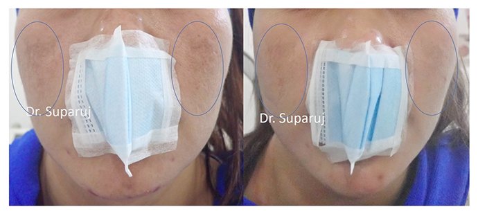 ดูแลฝ้าด้วยเทคนิคเลเซอร์ดึงเม็ดสีแบบแบ่งส่วน Fractional Laser for Melasma Treatment ดูแลฝ้าด้วยเทคนิคเลเซอร์ดึงเม็ดสีแบบแบ่งส่วน Fractional Laser for Melasma Treatment