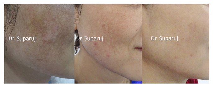 ดูแลฝ้าด้วยเทคนิคเลเซอร์ดึงเม็ดสีแบบแบ่งส่วน Fractional Laser for Melasma Treatment ดูแลฝ้าด้วยเทคนิคเลเซอร์ดึงเม็ดสีแบบแบ่งส่วน Fractional Laser for Melasma Treatment