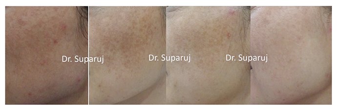 ดูแลฝ้าด้วยเทคนิคเลเซอร์ดึงเม็ดสีแบบแบ่งส่วน Fractional Laser for Melasma Treatment ดูแลฝ้าด้วยเทคนิคเลเซอร์ดึงเม็ดสีแบบแบ่งส่วน Fractional Laser for Melasma Treatment