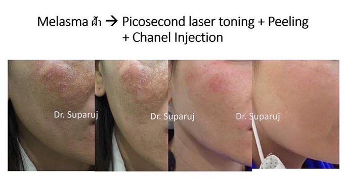 ดูแลฝ้าด้วยเทคนิคเลเซอร์ดึงเม็ดสีแบบแบ่งส่วน Fractional Laser for Melasma Treatment ดูแลฝ้าด้วยเทคนิคเลเซอร์ดึงเม็ดสีแบบแบ่งส่วน Fractional Laser for Melasma Treatment