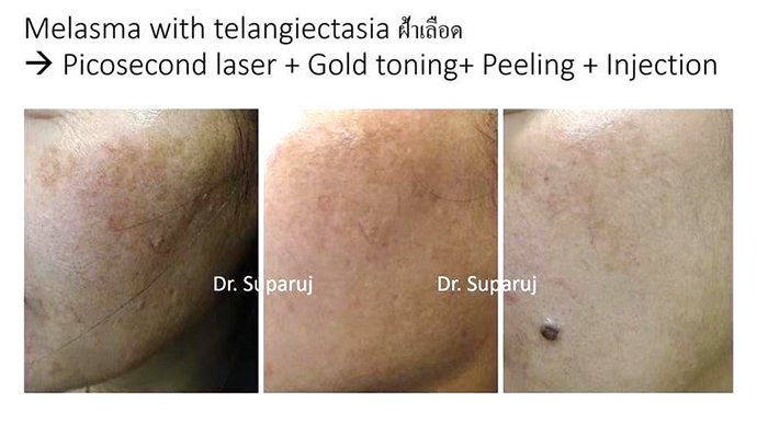 ดูแลฝ้าด้วยเทคนิคเลเซอร์ดึงเม็ดสีแบบแบ่งส่วน Fractional Laser for Melasma Treatment