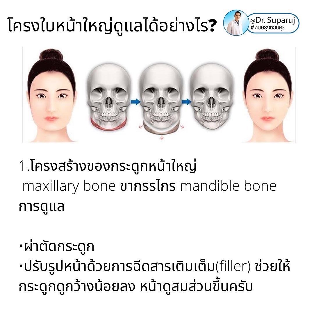 ทำไมไปฉีดโบทูลินั่มท็อกซินลดกราม แล้วหน้าไม่เรียวดั่งใจ เกิดจากอะไรได้บ้าง ? ทำไมไปฉีดโบทูลินั่มท็อกซินลดกราม แล้วหน้าไม่เรียวดั่งใจ เกิดจากอะไรได้บ้าง ?