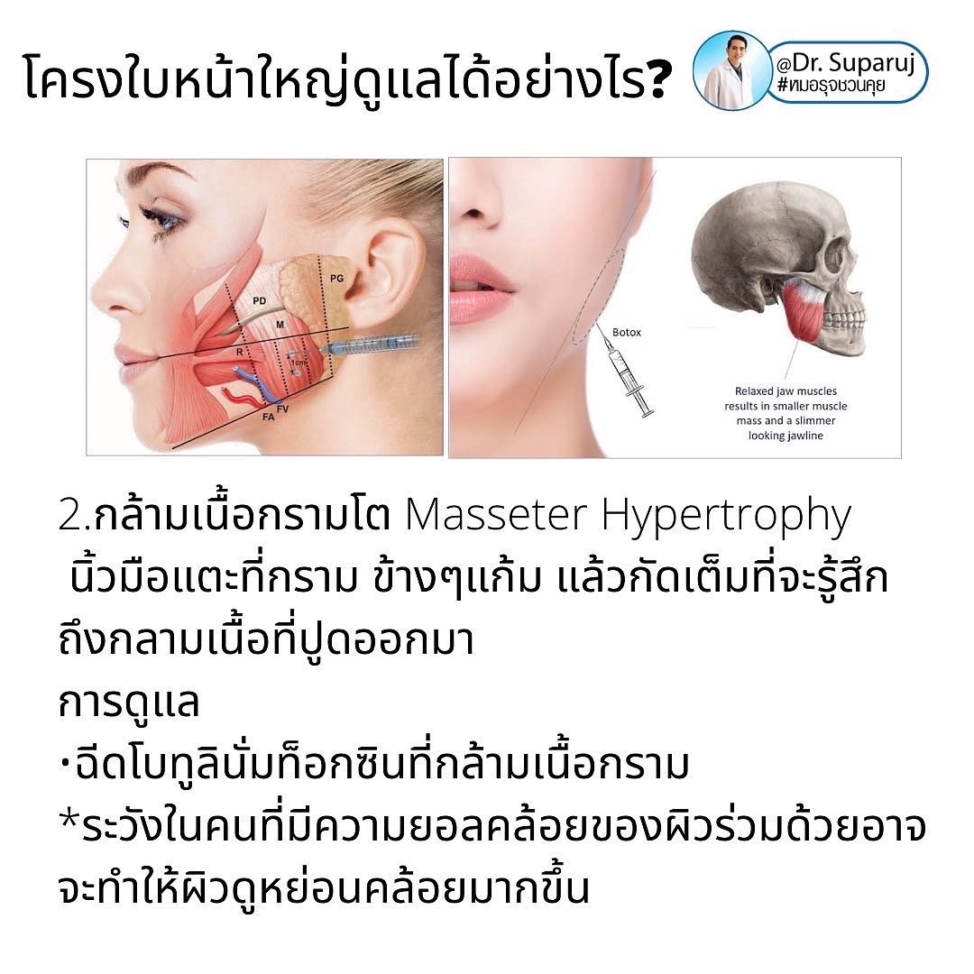 ทำไมไปฉีดโบทูลินั่มท็อกซินลดกราม แล้วหน้าไม่เรียวดั่งใจ เกิดจากอะไรได้บ้าง ? ทำไมไปฉีดโบทูลินั่มท็อกซินลดกราม แล้วหน้าไม่เรียวดั่งใจ เกิดจากอะไรได้บ้าง ?