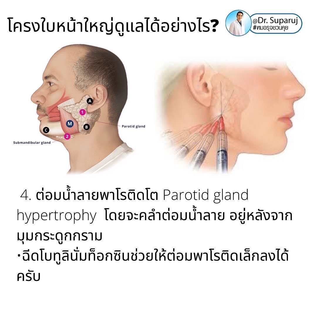 ทำไมไปฉีดโบทูลินั่มท็อกซินลดกราม แล้วหน้าไม่เรียวดั่งใจ เกิดจากอะไรได้บ้าง ? ทำไมไปฉีดโบทูลินั่มท็อกซินลดกราม แล้วหน้าไม่เรียวดั่งใจ เกิดจากอะไรได้บ้าง ?