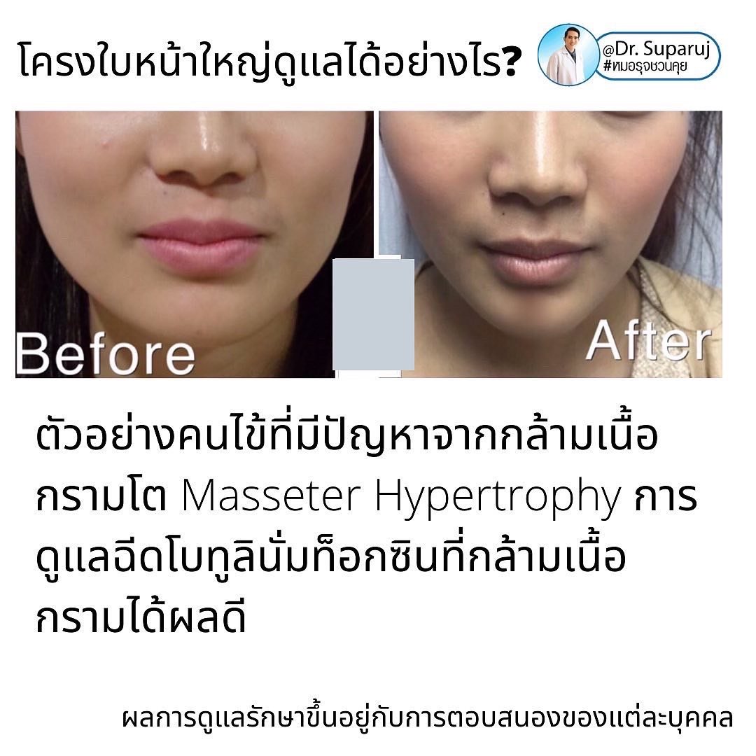 ทำไมไปฉีดโบทูลินั่มท็อกซินลดกราม แล้วหน้าไม่เรียวดั่งใจ เกิดจากอะไรได้บ้าง ? ทำไมไปฉีดโบทูลินั่มท็อกซินลดกราม แล้วหน้าไม่เรียวดั่งใจ เกิดจากอะไรได้บ้าง ?