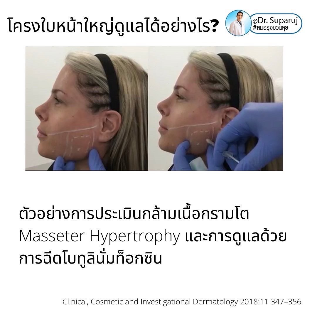 ทำไมไปฉีดโบทูลินั่มท็อกซินลดกราม แล้วหน้าไม่เรียวดั่งใจ เกิดจากอะไรได้บ้าง ? ทำไมไปฉีดโบทูลินั่มท็อกซินลดกราม แล้วหน้าไม่เรียวดั่งใจ เกิดจากอะไรได้บ้าง ?