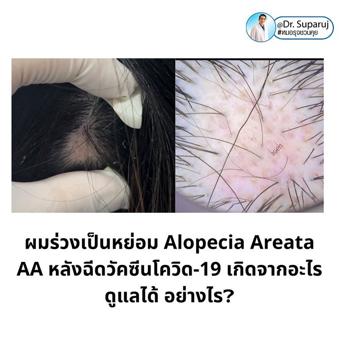 ภาวะผมร่วงเป็นหย่อม Alopecia Areata AA หลังฉีดวัคซีนโควิด-19 เกิดจากอะไรดูแลได้ อย่างไร? ภาวะผมร่วงเป็นหย่อม Alopecia Areata AA หลังฉีดวัคซีนโควิด-19 เกิดจากอะไรดูแลได้ อย่างไร?