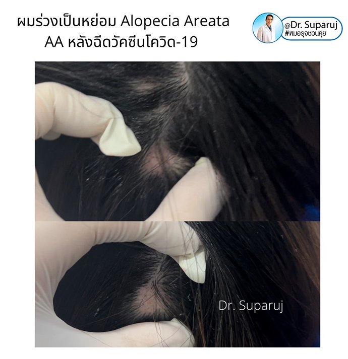 ภาวะผมร่วงเป็นหย่อม Alopecia Areata AA หลังฉีดวัคซีนโควิด-19 เกิดจากอะไรดูแลได้ อย่างไร? ภาวะผมร่วงเป็นหย่อม Alopecia Areata AA หลังฉีดวัคซีนโควิด-19 เกิดจากอะไรดูแลได้ อย่างไร?