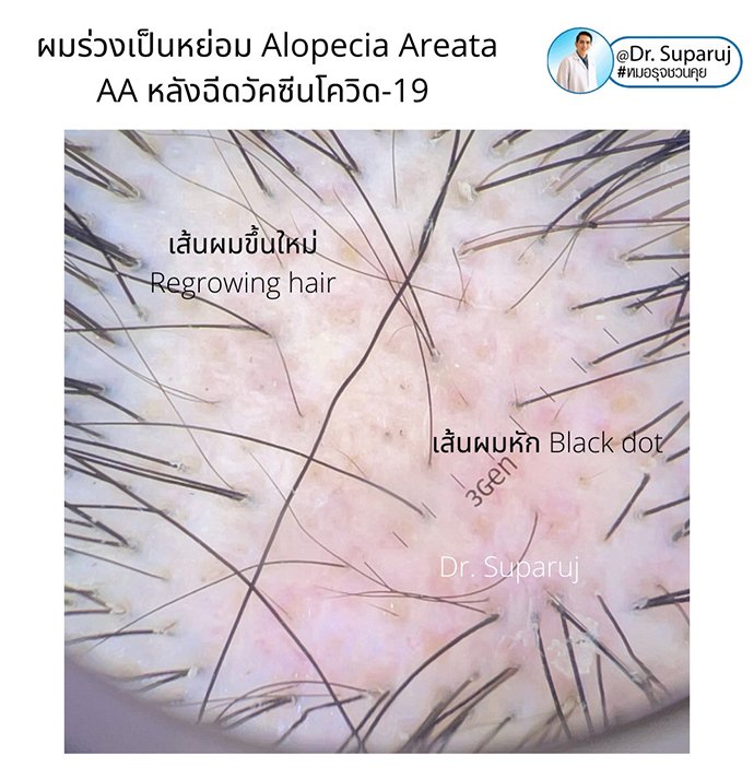ภาวะผมร่วงเป็นหย่อม Alopecia Areata AA หลังฉีดวัคซีนโควิด-19 เกิดจากอะไรดูแลได้ อย่างไร? ภาวะผมร่วงเป็นหย่อม Alopecia Areata AA หลังฉีดวัคซีนโควิด-19 เกิดจากอะไรดูแลได้ อย่างไร?