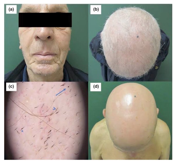 ภาวะผมร่วงเป็นหย่อม Alopecia Areata AA หลังฉีดวัคซีนโควิด-19 เกิดจากอะไรดูแลได้ อย่างไร? ภาวะผมร่วงเป็นหย่อม Alopecia Areata AA หลังฉีดวัคซีนโควิด-19 เกิดจากอะไรดูแลได้ อย่างไร?